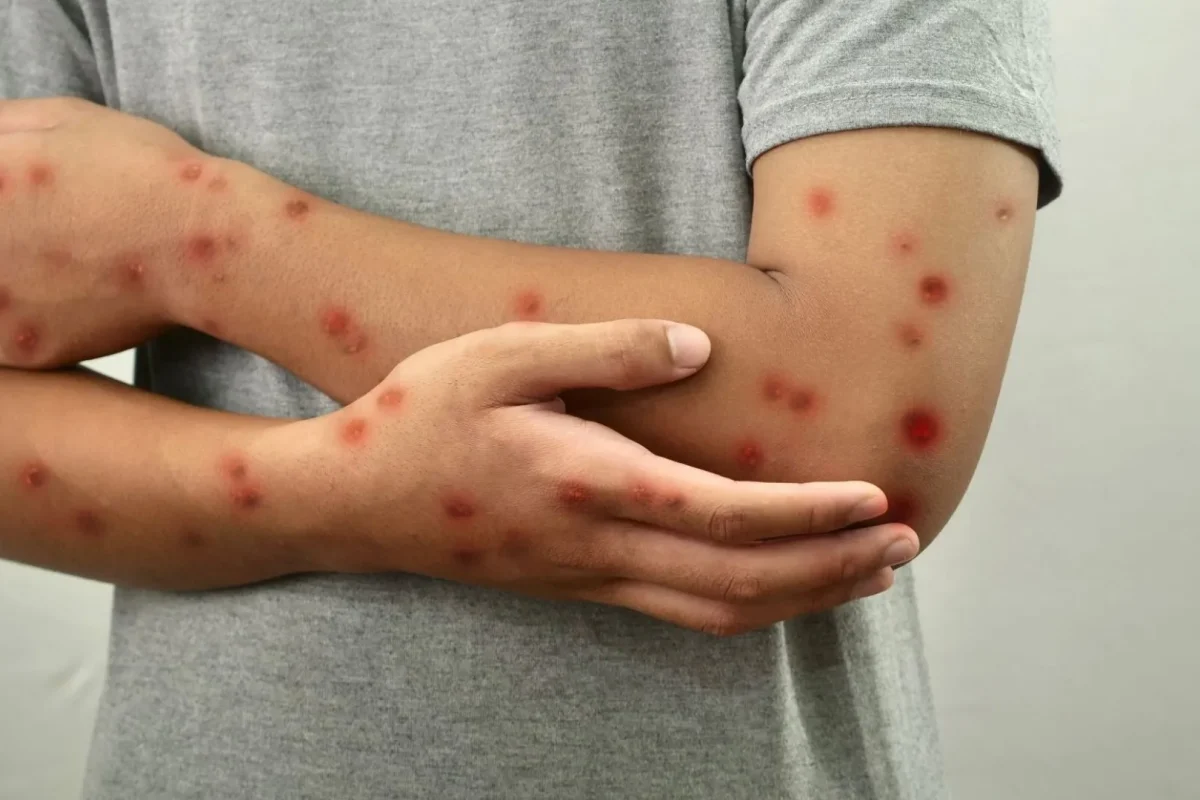 a-mpox-pertence-ao-mesmo-grupo-de-virus-da-variola-humana--f0b7f158d732bc40