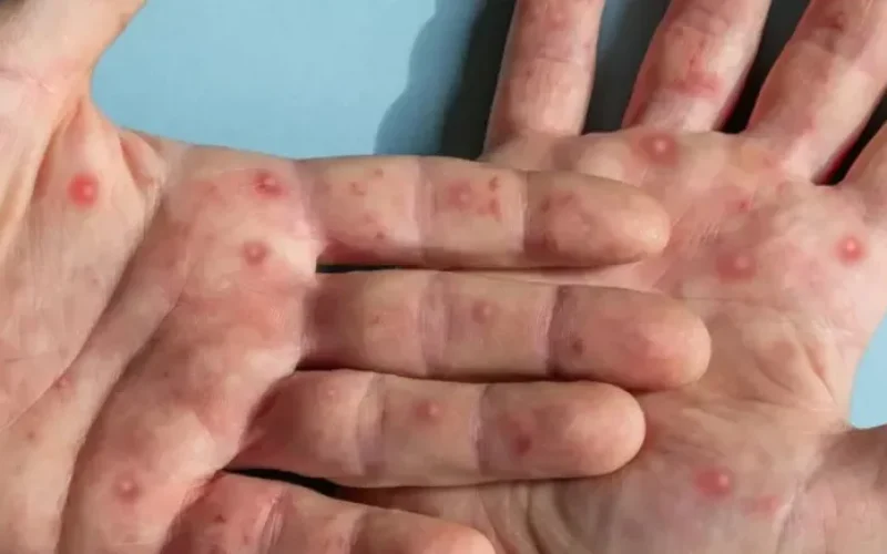 caso-de-mpox-e-confirmado-em-porto-alegre--2b47310102aea70e