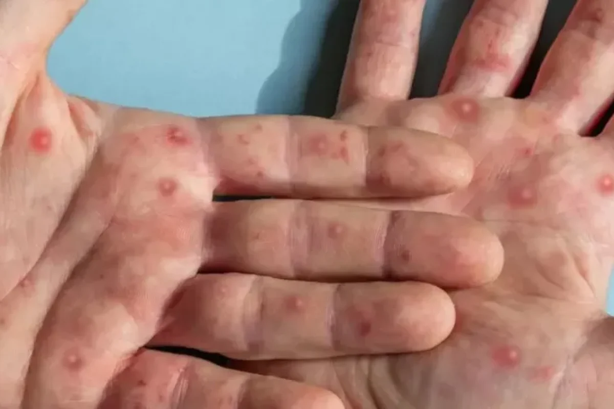 caso-de-mpox-e-confirmado-em-porto-alegre--2b47310102aea70e