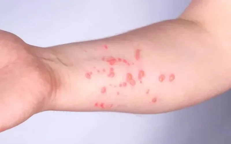 mpox-pode-causar-erupcoes-cutaneas--7b7c7b3f6c7b5985