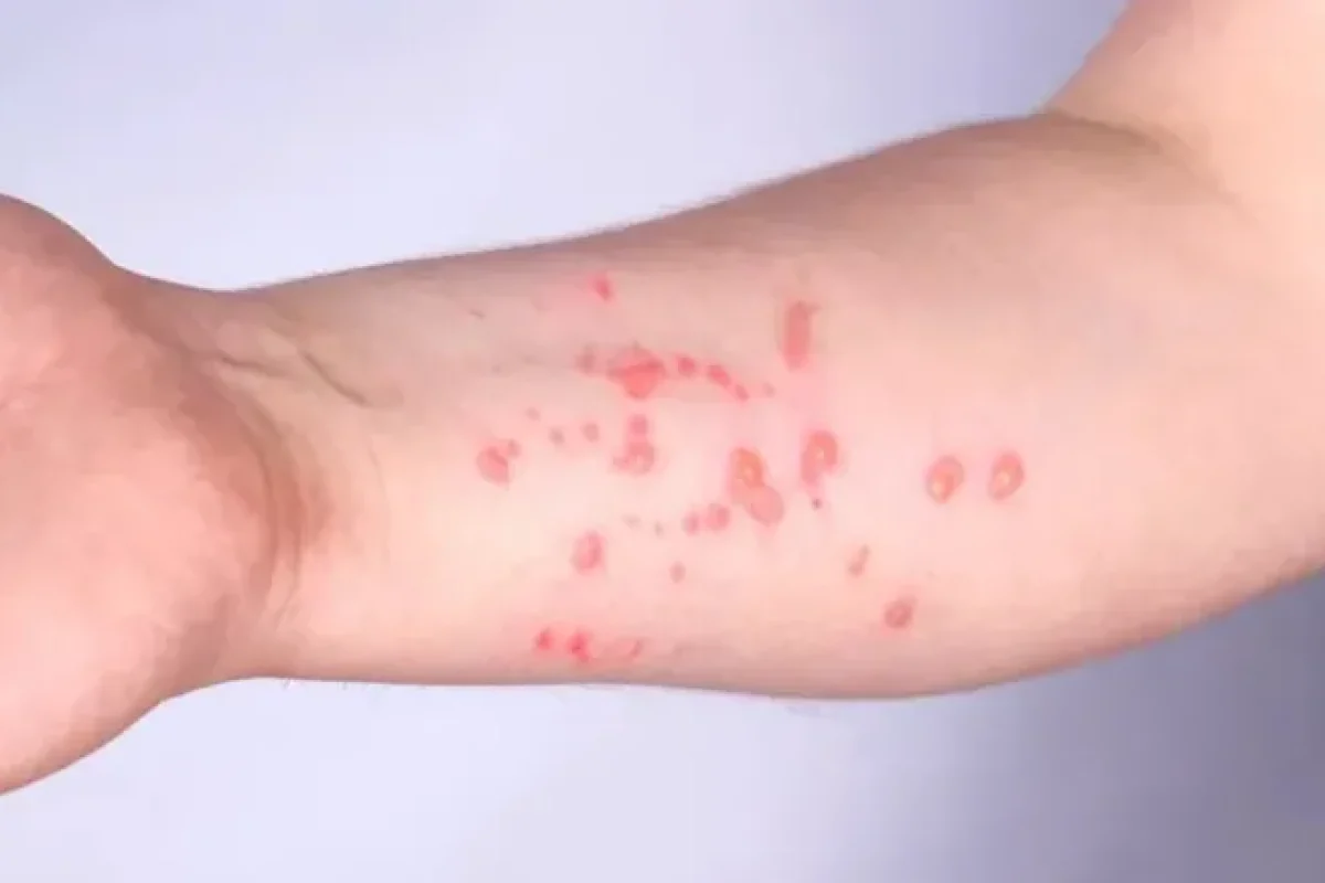 mpox-pode-causar-erupcoes-cutaneas--7b7c7b3f6c7b5985