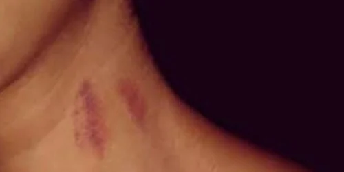 mulher-e-diagnosticado-com-avc-apos-levar-um-chupao-no-pesco.jpg.1200x0_q95_crop